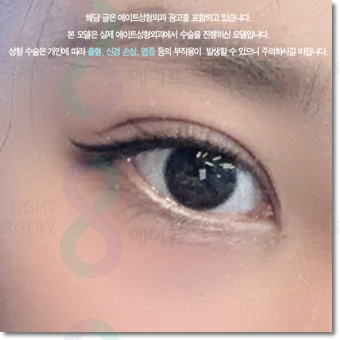 쌍수 가격은 평균적으로 얼마일까요? 매몰과 비절개? 절개 차이점까지 관련 이미지 3