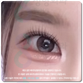 수술 가격이 다른 이유? 매몰과 절개 어떤 쌍꺼풀 재수술을 해야할까? 관련 이미지 3