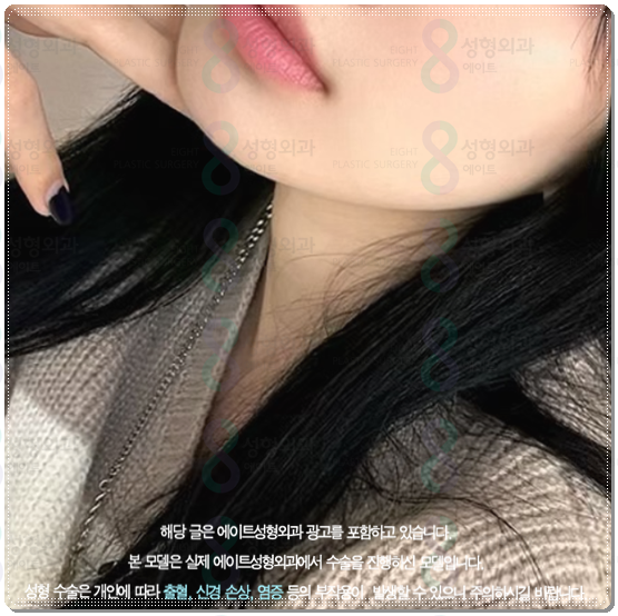 울쎄라 300샷 가격과 효과는? 100샷 후기&middot;전후 차이까지 비교 관련 이미지 2