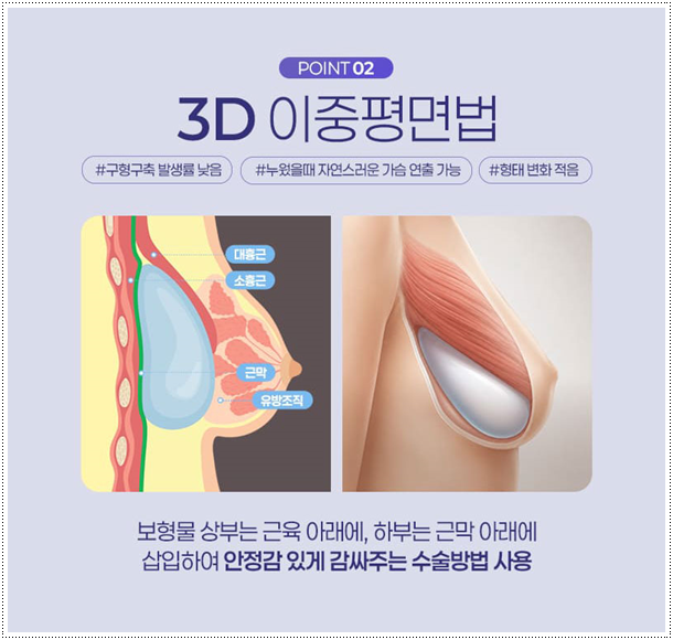 가슴 절벽 걱정? 가슴확대 수술 비용과 촉감, 후기 만족에 대해서 (멘토 스무스) 관련 이미지 6