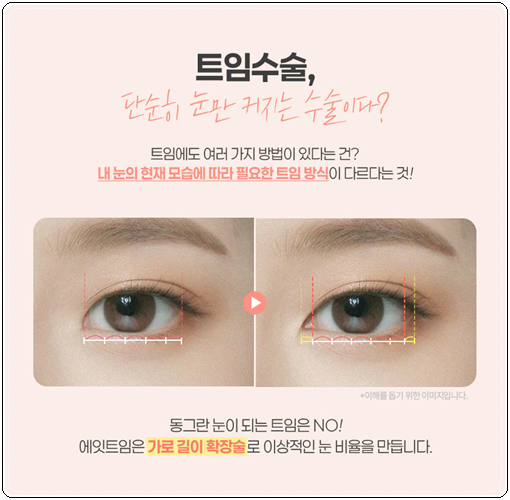 쌍커풀 하고 앞트임 수술을 해도될까? 쌍수 이후 라인 변화에 대해서 관련 이미지 6