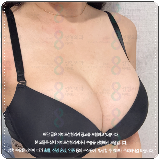 Pear-Shaped Breast Augmentation: Real-Review-Based Guide to Recovery Time, Feel, and Cost image 1