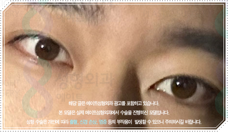 남자 쌍수 비용, 눈매교정 · 앞트임까지 하면 얼마나 달라질까? 관련 이미지 4