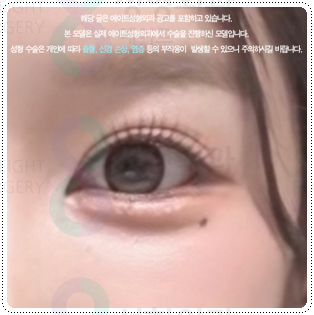 강남 쌍커플 알아볼 때, 가격보다 먼저 확인해야 할 것 관련 이미지 5