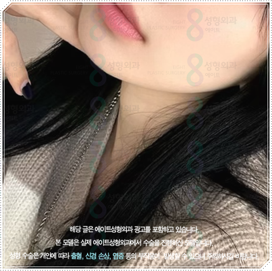 울쎄라피프라임 효과 얼마나 갈까? 300샷 통증과 후기, 가격까지 관련 이미지 5