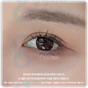 강남눈성형 | 쌍수 병원을 찾는다면? 비용, 후기, 선택전에 체크해보세요 관련 이미지 1