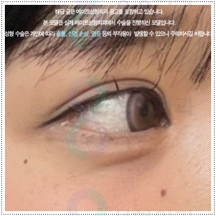 매몰쌍수와 앞트임 그리고 뒷트임, 밑트임까지 같이해도되나요? 관련 이미지 1
