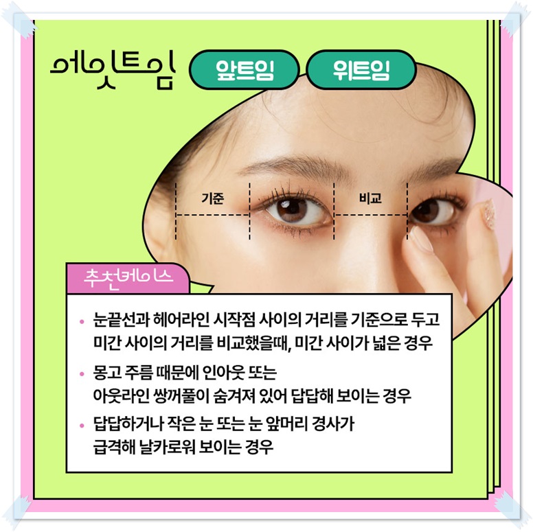 Which Eyes Need a Difference Before and After Epicanthoplasty? image 6