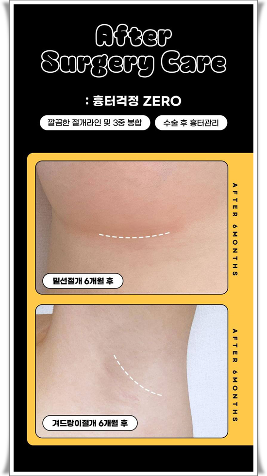 가슴확대 수술 가격, 보형물 종류 차이가 있나요? 관련 이미지 16