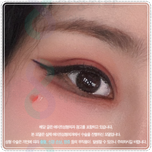 Suture or Incision? Which Double-Eyelid Design Looks Best? Understanding the Differences Between In-Out and In-Line Creases, Including the Semi-Out Line image 2