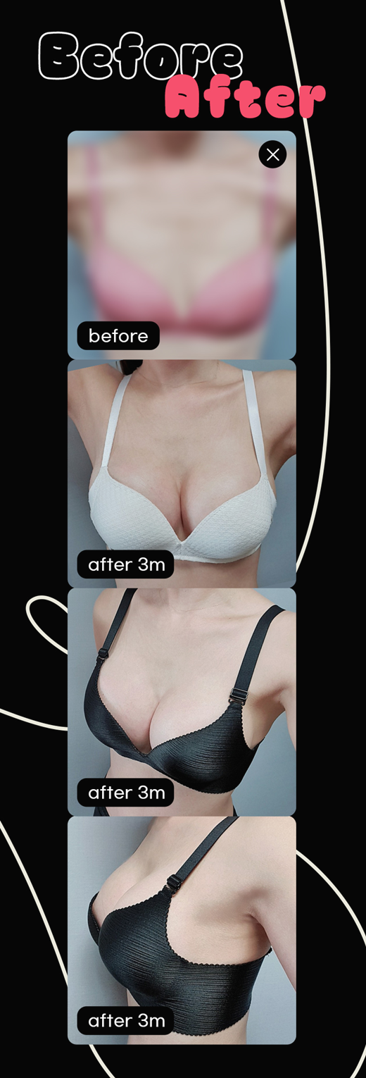 Choosing the Right Type of Breast Augmentation image 1