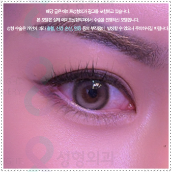 눈 앞트임과 윗트임 준비, 내돈내산 후기를 찾아볼 때 수술 전후 확인할 것 (비용 등) 관련 이미지 4