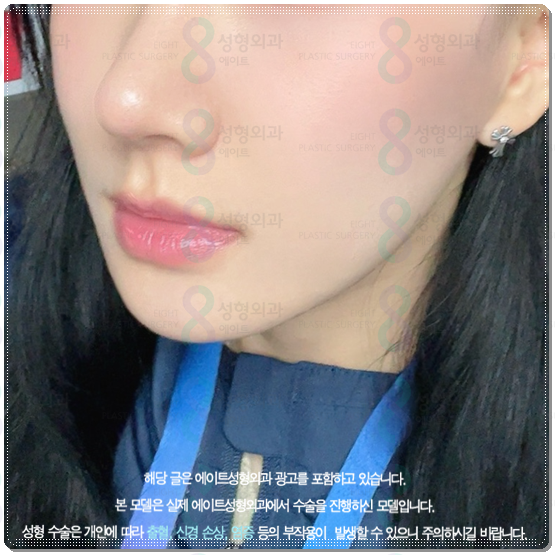 울쎄라 300샷 가격과 효과는? 100샷 후기&middot;전후 차이까지 비교 관련 이미지 5