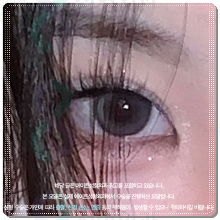How Much Does Non-Incisional Double-Eyelid Surgery Cost? Comparing Suture and Incisional Methods image 2