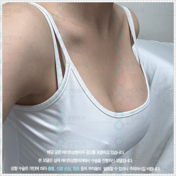 가슴성형수술 비용 얼마나 하나? 가슴성형 수술 후기와 부작용 낮추는 방법 관련 이미지 5
