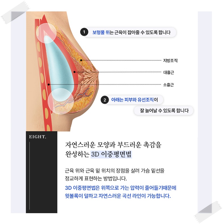 가슴보형물종류 어떤것이 좋은걸까? 관련 이미지 5