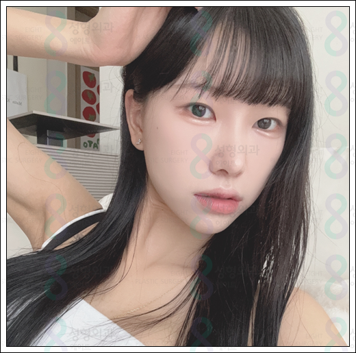 매부리코 수술 비용 후기 정보 총정리 관련 이미지 4