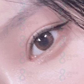 Eyelid Correction Surgery Review: Famous Eyelid Correction Clinic, Ptosis Surgery Before and After image 3