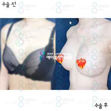 가슴확대수술후기 전후 멘토스무스 350cc 관련 이미지 1