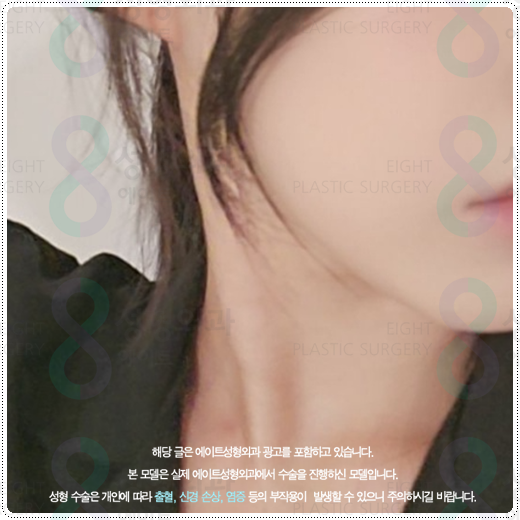 울쎄라 샷 수, 600샷과 300샷 차이점? 부작용 걱정과 가격 부담을 낮추려면 관련 이미지 2