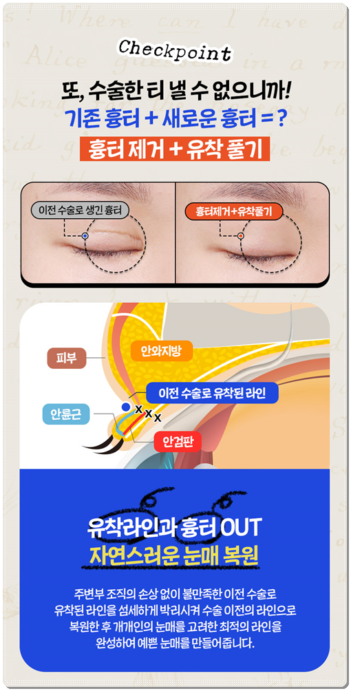 쌍꺼풀 라인을 다시 잡는 재수술, 매몰 방법과 비용은? 관련 이미지 13