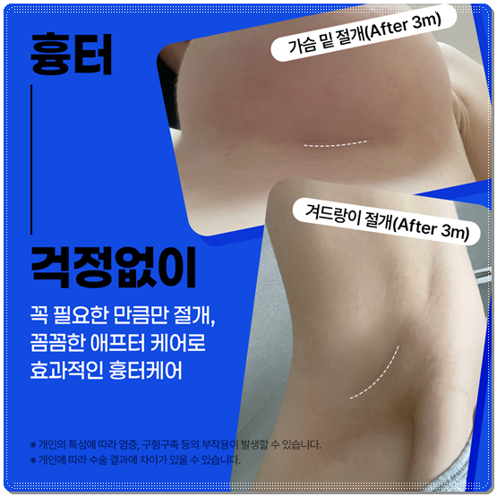 Cost Differences for Teardrop-Type Breast Surgery, Recovery Time for Swelling to Subside, and Implant Feel image 7
