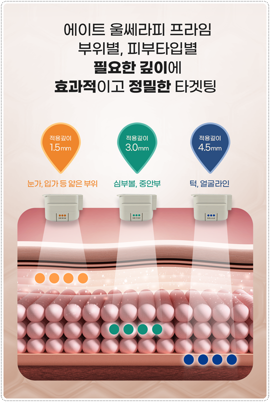 Ultherapy Lifting with 300 Shots: What Are the Price and Before-and-After Changes You Should Know Before the Procedure? image 12