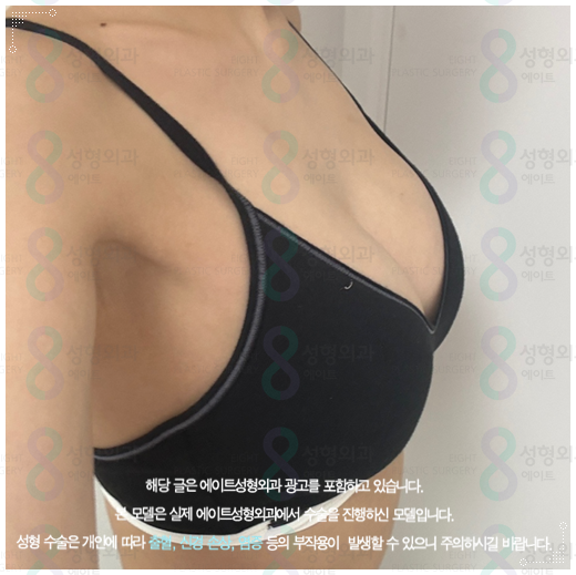 처진가슴 리프팅 수술, 출산후 수유후, 가슴 올리기, 보형물로 가능한가요? 관련 이미지 5