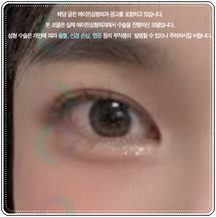 쌍커풀 하고 앞트임 수술을 해도될까? 쌍수 이후 라인 변화에 대해서 관련 이미지 4