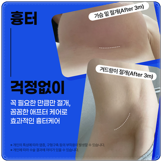 Pear-Shaped Breast Augmentation: Real-Review-Based Guide to Recovery Time, Feel, and Cost image 6