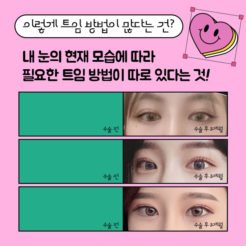 If You Compare Reviews of Outer and Lower Canthoplasty Carefully image 2