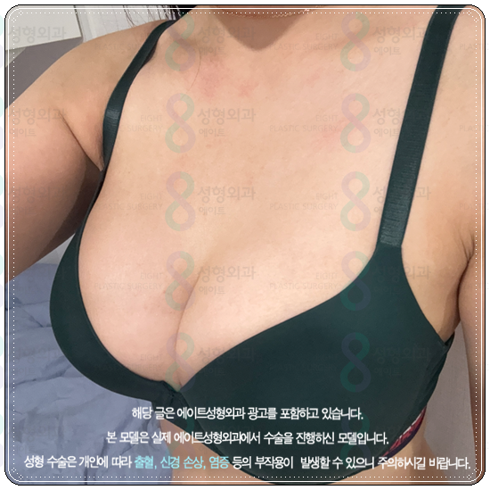 Pear-Shaped Breast Augmentation: Real-Review-Based Guide to Recovery Time, Feel, and Cost image 2