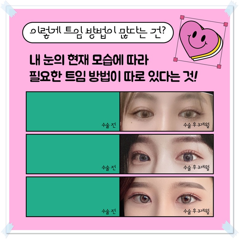 Which Eyes Need a Difference Before and After Epicanthoplasty? image 3