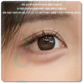 Ptosis Correction Cost: What Are the Criteria for Choosing Non-Incisional or Incisional Surgery? image 3