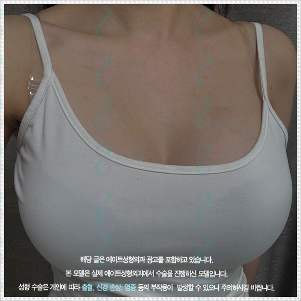 가슴성형수술 비용 얼마나 하나? 가슴성형 수술 후기와 부작용 낮추는 방법 관련 이미지 1