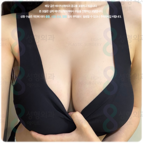 가슴확대수술, 후기와 비용·붓기·회복 기간은 어떻게 될까? 관련 이미지 3