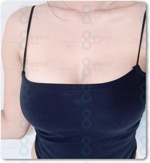 Breast Augmentation Surgery Review: Implants, Recovery Time, and How to Minimize Side Effects image 4