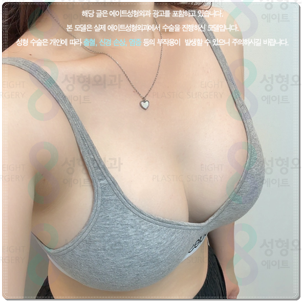 Are You Curious About the Cost of Breast Augmentation Surgery? Understanding the Differences Between Mentor Xtra and Smooth image 5