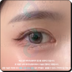 쌍꺼풀수술은 꼭 비절개가 좋을까? 부분절개와 절개의 비용 대비 효과는? 관련 이미지 5