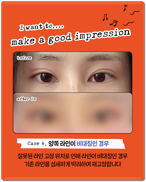 쌍꺼풀 라인을 다시 잡는 재수술, 매몰 방법과 비용은? 관련 이미지 10