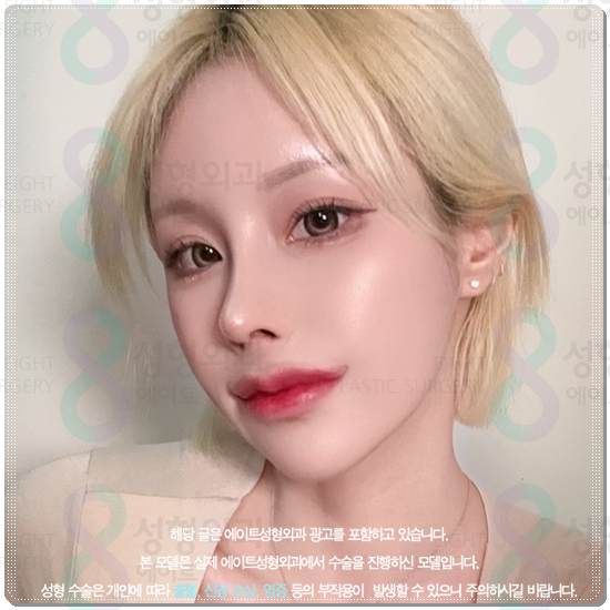 How Much Is a Reasonable Cost for Non-Incisional Ptosis Correction to Escape Sleepy-Looking Eyes? (Including the Differences from Incisional Surgery and Recovery Time) image 3