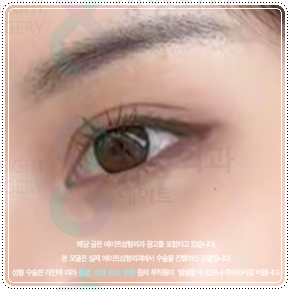 첫 쌍꺼풀 수술을 절개로 하고 눈 재수술은 매몰법(자연유착)으로 못하나? 비용 붓기는? 관련 이미지 3