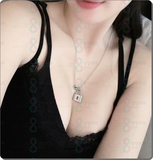 가슴 보형물 종류 모티바 특징 무엇인가요? 관련 이미지 3