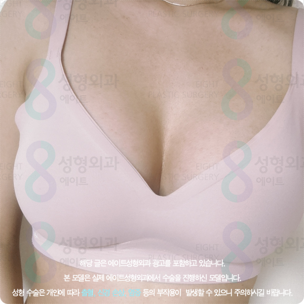 Apgujeong Plastic Surgery Clinics: Sharing Information on Breast Augmentation and Motiva Surgery image 3