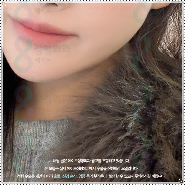 처지는 피부 고민? 리프팅 중 울쎄라 100샷은 300샷과 가격이나 효과가 많이 다른가요? (울쎄라피프라임) 관련 이미지 2