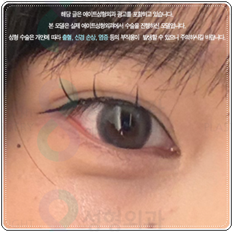 자연유착 매몰, 절개 차이 비교해봐요. 풀림 걱정없이 눈성형 비용과 후기 참고하는법 관련 이미지 3