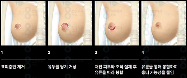 What Is the Difference Between Breast Ptosis Surgery and Breast Augmentation? image 10