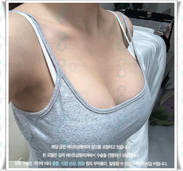 처진가슴수술 방법은? 가슴성형 보형물 선택과 멘토부스트 후기 특징 정리 관련 이미지 4