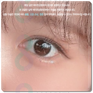 자연유착쌍커플 후기, 쌍수 할 때 재수술 없이 성공하려면? (비용 문의) 관련 이미지 4