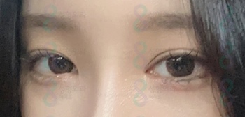Eyelid Correction Surgery Review: Famous Eyelid Correction Clinic, Ptosis Surgery Before and After image 1
